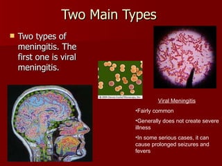 Two Main Types  Two types of meningitis. The first one is viral meningitis.  Viral Meningitis   Fairly common Generally does not create severe illness In some serious cases, it can cause prolonged seizures and fevers 