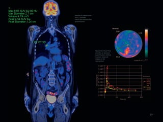 Volume of interest with
SUVpeak provides
robust and reproducible
quantification




                          Myocardial blood flow
                          provides an absolute
                          quantification method
                          to assess balanced
                          disease in the
                          myocardium




                                                  23
 