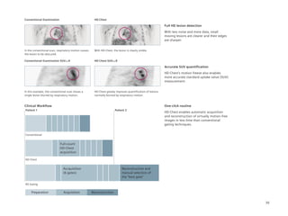 Conventional Examination                               HD·Chest

                                                                                                             Full HD lesion detection
                                                                                                             With less noise and more data, small
                                                                                                             moving lesions are clearer and their edges
                                                                                                             are sharper.


In the conventional scan, respiratory motion causes    With HD·Chest, the lesion is clearly visible.
the lesion to be obscured.

Conventional Examination SUVmax4                       HD·Chest SUVmax9

                                                                                                             Accurate SUV quantification
                                                                                                             HD·Chest’s motion freeze also enables
                                                                                                             more accurate standard uptake value (SUV)
                                                                                                             measurement.


In this example, the conventional scan shows a         HD·Chest greatly improves quantification of lesions
single lesion blurred by respiratory motion.           normally blurred by respiratory motion.


Clinical Workflow                                                                                            One-click routine
Patient 1                                                               Patient 2
                                                                                                             HD·Chest enables automatic acquisition
                                                                                                             and reconstruction of virtually motion-free
                                                                                                             images in less time than conventional
                                                                                                             gating techniques.


Conventional


                            Full-count
                            HD·Chest
                            acquisition

HD·Chest


                              Accquisition                                    Reconstruction and
                              (6 gates)                                       manual selection of
                                                                              the “best gate”

4D	Gating


     Preparation              Acquisition             Reconstruction


                                                                                                                                                           39
 