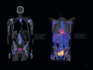 Biograph mCT optimizes every   ultraHD·PET brings uniform
componet of the detection      resolution throughout the field
system into a superbly         of view and 4 times the
designed imaging chain,        improvement in signal-to-noise
for excellent image quality




                                                           41
 