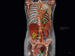 Whole-body PET with half
injected dose and a 5-minute
acquisition time




                           57
 