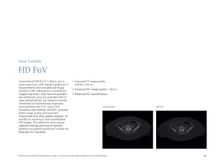 How it works

 HD FoV
  Conventional FOV for CT is 50 cm, but in                •	 Improved	CT	image	quality	
  some cases (e.g., with bariatric patients) CT              and HU > 50 cm
  measurements are truncated and image
                                                          •	 Enhanced	PET	image	quality	>	50	cm
  artifacts in PET attenuation-corrected (AC)
  images may result. Until now this problem               •	 Advanced	PET	quantification
  was addressed using the extended field of
  view method (EFoV), but Siemens recently
  introduced an improved way to process
  truncated data sets in CT scans. This                                                  Conventional   HD FoV
  innovative new method, HD FoV*, provides
  better image quality and improved
  Houndsfield Unit (HU) stability between 50
  and 65 cm resulting in more quantitative
  PET images. This allows for more precise
  radiation therapy planning for bariatric
  patients and patients positioned outside the
  Biograph mCT isocenter.




* HD FoV is pending 510k clearance, and is not yet commercially available in the United States.                  65
 