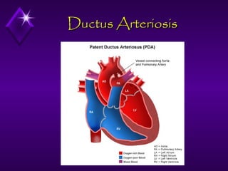 Ductus Arteriosis

 