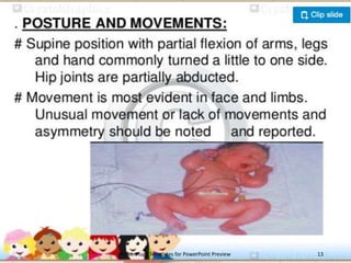 Sandifer Position Newborn-Assessment.pptx