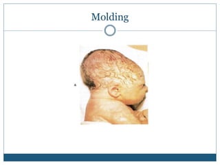 Positional Molding pediatrics Newborn-Assessment-and-Care-2.ppt