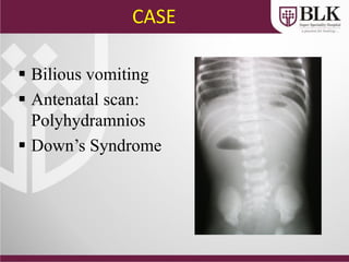 CASE
 Bilious vomiting
 Antenatal scan:
Polyhydramnios
 Down’s Syndrome
 