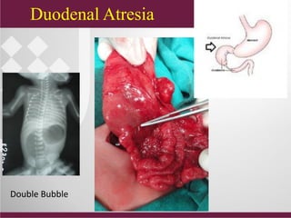 Duodenal Atresia
Double Bubble
 