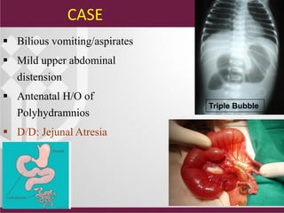  Bilious vomiting/aspirates
 Mild upper abdominal
distension
 Antenatal H/O of
Polyhydramnios
 D/D: Jejunal Atresia
Triple Bubble
CASE
 