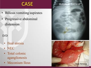 • Bilious vomiting/aspirates
• Progressive abdominal
distension
Multiple air fluid level
Ileal Atresia
• Ileal atresia
• NEC
• Total colonic
aganglionosis
• Meconium Ileus
D/D
CASE
 