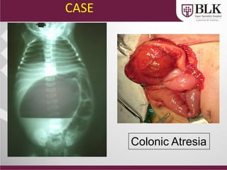 Colonic Atresia
CASE
 