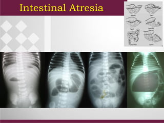 Intestinal Atresia
 