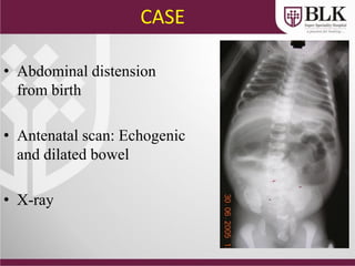 CASE
• Abdominal distension
from birth
• Antenatal scan: Echogenic
and dilated bowel
• X-ray
 