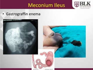 Meconium Ileus
• Gastrograffin enema
 