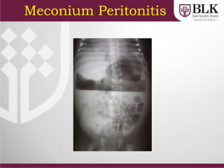 Meconium Peritonitis
 