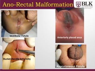 Ano-Rectal Malformation
Vestibular Fistula
Anteriorly placed anus
Bucket Handle deformity
Anocutaneous Fistula
 