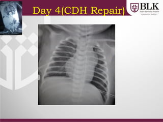 Day 4(CDH Repair)
 