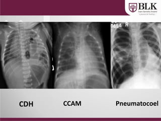 CDH CCAM Pneumatocoel
 