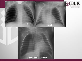 pneumothorax
CLE CLE
 