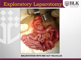 MALROTATION WITH MID GUT VOLVULUS
Exploratory Laparotomy
 