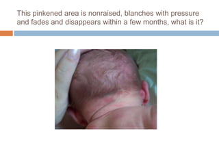 This pinkened area is nonraised, blanches with pressure and fades and disappears within a few months, what is it?