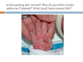 Is this peeling skin normal? Why do you think it looks yellow as if stained? What could have caused this?