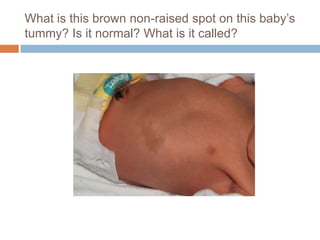 What is this brown non-raised spot on this baby’s tummy? Is it normal? What is it called?