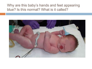 Why are this baby’s hands and feet appearing blue? Is this normal? What is it called?