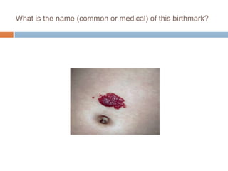 What is the name (common or medical) of this birthmark?