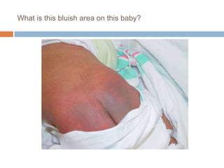 What is this bluish area on this baby?