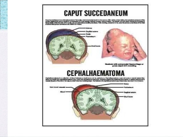 caput succedaneum