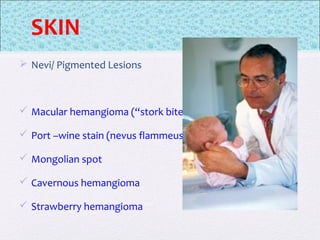 SKIN
 Nevi/ Pigmented Lesions
 Macular hemangioma (“stork bites”)
 Port –wine stain (nevus flammeus)
 Mongolian spot
 Cavernous hemangioma
 Strawberry hemangioma
 