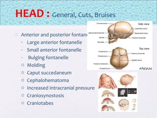 HEAD : General, Cuts, Bruises
o Anterior and posterior fontanelles
- Large anterior fontanelle
- Small anterior fontanelle
- Bulging fontanelle
o Molding
o Caput succedaneum
o Cephalohematoma
o Increased intracranial pressure
o Craniosynostosis
o Craniotabes
 