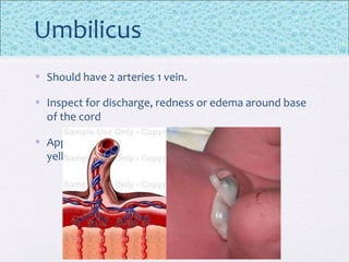 Umbilicus
• Should have 2 arteries 1 vein.
• Inspect for discharge, redness or edema around base
of the cord
• Appearance : should be translucent. A greenish
yellowish colour suggest meconium staining
 