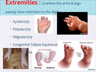 Extremities : Examine the arms & legs
paying close attention to the digits
• Syndactyly
• Polydactyly
• Oligodactyly
• Congenital Talipes Equinovarus (CTEV)
• Metarsus Varus
 