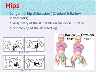 Hips
• Congenital hip dislocation ( Ortolani & Barlow
Maneuvers)
• Assymetry of the skin folds on the dorsal surface
• Shortening of the affected leg
 