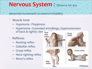 Nervous System : Observe for any
abnormal movement/ excessive irritability
• Muscle tone
– Hypotonia : Floppiness
– Hypertonia : Extended arms&legs, hyperextension
of back & tightly clenched fists.
• Reflexes
– Rooting reflex
– Glabellar reflex
– Grasp reflex
– Neck righting reflex
– Moro’s reflex
 