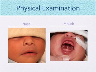 Physical Examination
Nose Mouth
 