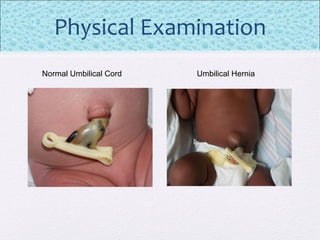 Physical Examination
Normal Umbilical Cord Umbilical Hernia
 