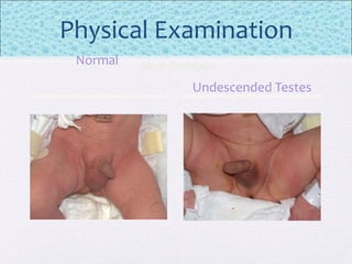Physical Examination
Normal
Undescended Testes
Male Genitalia
 