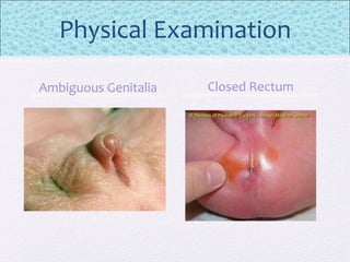 Physical Examination
Ambiguous Genitalia Closed Rectum
 