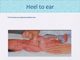 Heel to ear
0 if he heel can easily be pulled to ear
 
