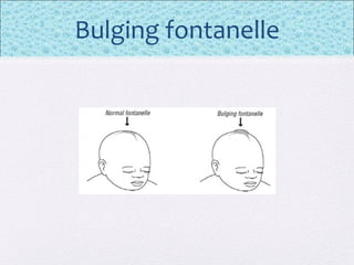 Bulging fontanelle
 