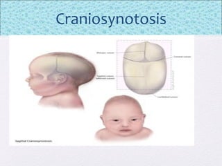 Craniosynotosis
 