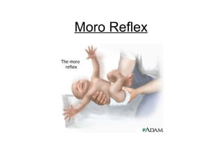 Moro Reflex
 