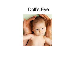 Doll’s Eye
 