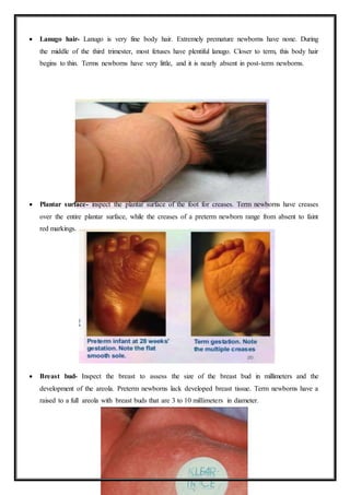  Lanugo hair- Lanugo is very fine body hair. Extremely premature newborns have none. During
the middle of the third trimester, most fetuses have plentiful lanugo. Closer to term, this body hair
begins to thin. Terms newborns have very little, and it is nearly absent in post-term newborns.
 Plantar surface- inspect the plantar surface of the foot for creases. Term newborns have creases
over the entire plantar surface, while the creases of a preterm newborn range from absent to faint
red markings.
 Breast bud- Inspect the breast to assess the size of the breast bud in millimeters and the
development of the areola. Preterm newborns lack developed breast tissue. Term newborns have a
raised to a full areola with breast buds that are 3 to 10 millimeters in diameter.
 