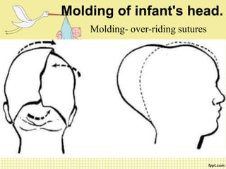 Positional Molding Newborn assessment | PPT
