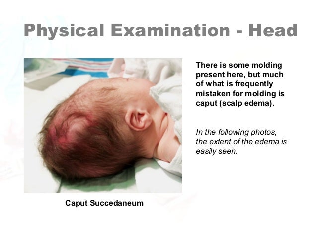 Why Is A Neonate’s Head More “moldable”? Newborn Assessment by Hadi Hospital NICU.