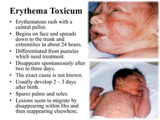 Erythema Toxicum
• Erythematous rash with a
central pallor.
• Begins on face and spreads
down to the trunk and
extremities in about 24 hours.
• Differentiated from pustules
which need treatment.
• Disappears spontaneously after
two to three days.
• The exact cause is not known.
• Usually develop 2 – 3 days
after birth.
• Spares palms and soles.
• Lesions seem to migrate by
disappearing within Hrs and
then reappearing elsewhere.
 