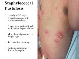Staphylococcal
Pustulosis
• Usually at 3-5 days.
• Discrete pustules with
erythematous base.
• Diaper area, periumbilical,
neck, lateral aspect of chest.
• More than 10 pustules is a
danger sign.
• T/t- betadine cleaning.
• Systemic antibiotics
Screen for sepsis
 